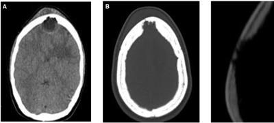 Case Report: Pott's Edematous Tumor: Complicated Frontal Sinusitis - An Unremembered Diagnosis